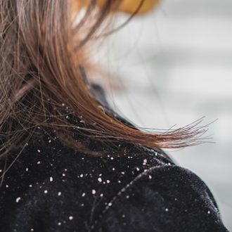 closeup woman hair with dandruff falling on shoulders